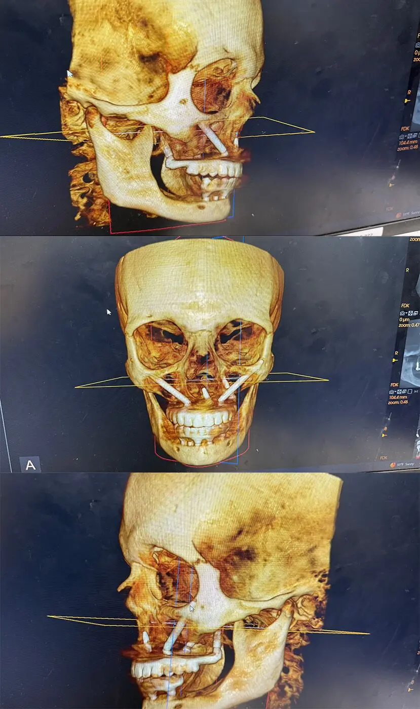 CBCT renderings of atrophic arches used in remote anchorage planning