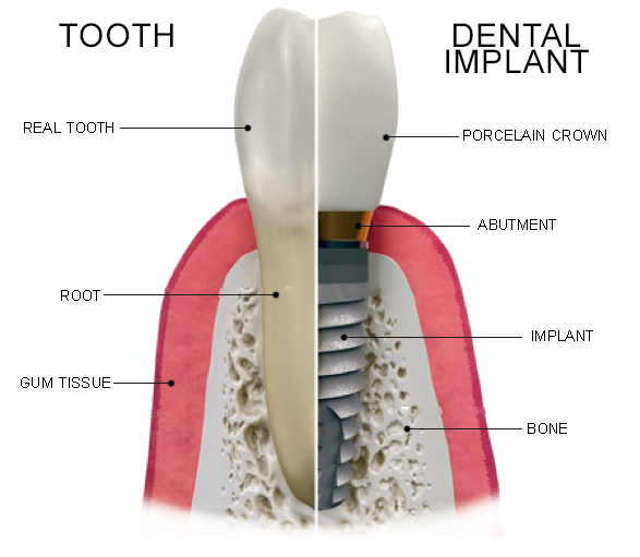dental implant tooth illustration