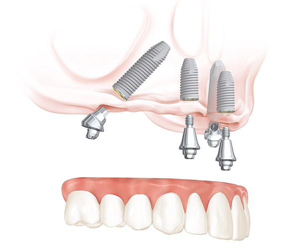full-arch dental implant illustration