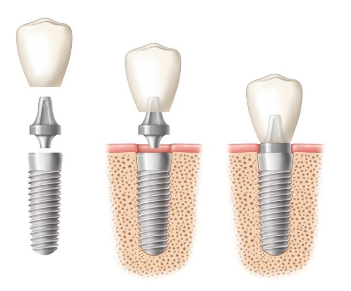 Dental implant with abutment in bone illustration
